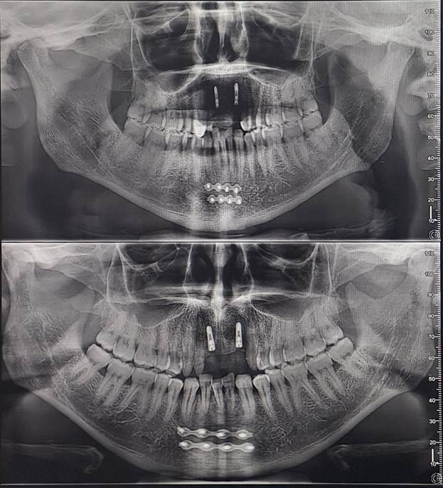 A close-up of a x-ray of a skull

Description automatically generated